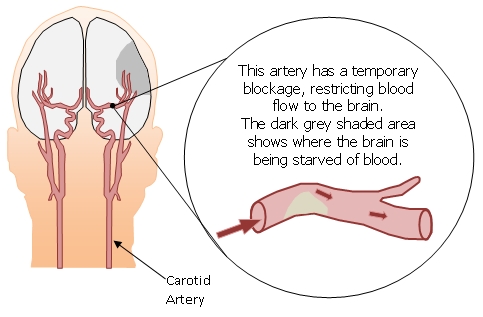 Transient Ischemic Attack-TIA