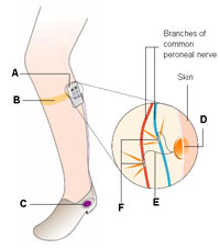 Diagram of STIMuSTEP dropped foot system