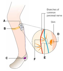 Finetech's Dropped Foot System