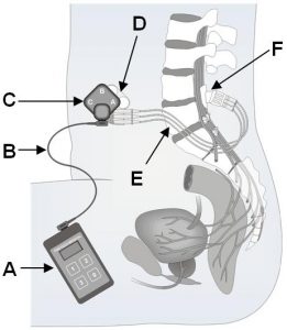 SARS system