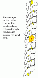 Spinal Cord Injury